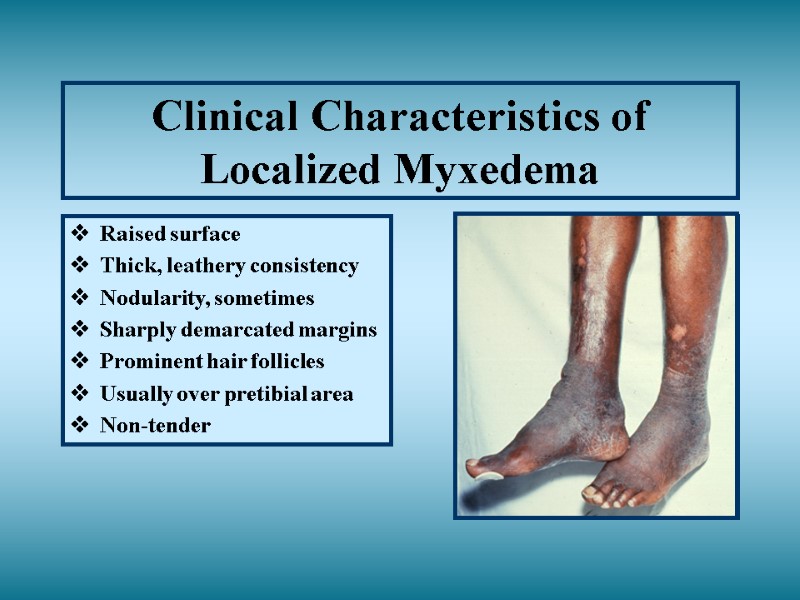 Clinical Characteristics of Localized Myxedema Raised surface Thick, leathery consistency Nodularity, sometimes Sharply demarcated